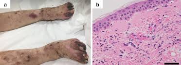 Infectious pathophysiologic mechanisms may be from direct vascular injury, vascular occlusion from septic emboli and disseminated intravascular coagulation (dic). Vasculitis With Nonpalpable Purpura Resembling Purpura Fulminans Springerlink