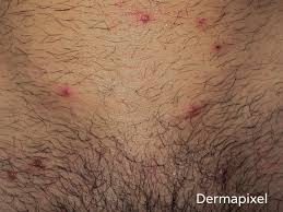 Dermapixel Unos Granos En El Pubis