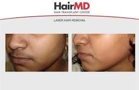 I had full body laser even in my butt lol. Facial Laser Hair Removal Before And After Results Laser Hair Removal Hair Removal Laser Hair Removal Treatment