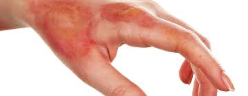 Although most chemical burns require only first. Hand Burns Plano Tx Libra Occupational Therapy