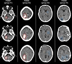 A computed tomography (ct or cat) scan allows doctors to see inside your body. Automated Detection Of Brain Lesions From Stroke Ct Scans In This Download Scientific Diagram