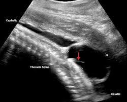 Image result for Spinal Dysraphism