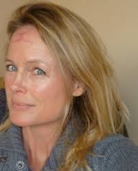 Skin cancer: nodular basal-cell carcinoma tumor