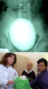 This 2 5lb And 17 Cm In Diameter Kidney Stone Was Removed From A Patient In Hungary World S Largest Calculos Renales Funny Ser Raro