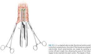 Mild to moderate diarrhea may occasionally persist for weeks to months after surgery, and some cats may have recurrent constipation. Transverse Colectomy Open Technique Abdominal Key