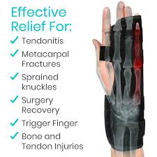 Image result for Ulnar Gutter Splint