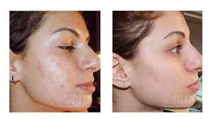 If you below are a list of healthy habits and practices that help you maintain a beautiful and healthy skin tone and texture. Micro Needling Vancouver Before After Microneedling Skin Treatments Skin Care Clinic