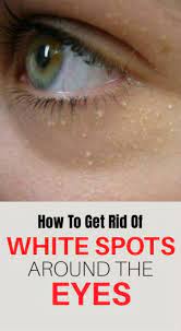 How To Get Rid Of White Spots Around The Eyes Creativity1 Creativity1 Eye Care Design Eye Care Health Eye Care P Skin Tag On Eyelid Skin Spots White Spot
