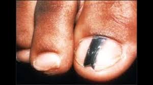 The cancer is actually underneath the nail, in the matrix, and it shows through the nail. Foot Toe And Toenail Cancer Causes Symptoms Best Treatment