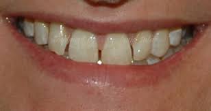 You would not want to do this if the gap space is significant, as you'd not have good symmetry and esthetics. 4 Methods To Close Gaps Between Teeth Trusted Dental Gold Coast
