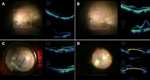 This encourages them to work together. Assessment Of The Electronic Retinal Implant Alpha Ams In Restoring Vision To Blind Patients With End Stage Retinitis Pigmentosa Sciencedirect