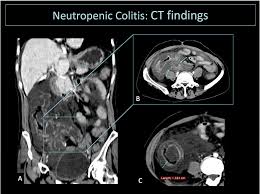 Image result for Neutropenic Colitis