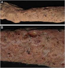Criptococose cutânea primária – Histórico, conceitos, atualização clínica e  terapêutica | Anais Brasileiros de Dermatologia (Portuguese)