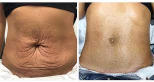 First charge is $68.89, then day after is $29.90 then week and a half later another charge for $40.62 from million dollar body! Lisa Smales Aesthetics On Twitter Insane Results By A Fellow Platinum Tech Million Dollar Body After 1 Yes 1 Treatment Well Done Katie Housby Https T Co Dcnxdxcbov