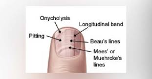 Image result for Muehrcke Line