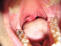 Many people don't even think about their uvula or may not even know what. My Big Fat Swollen Uvula Thanks To An Apparently Graceless Flickr