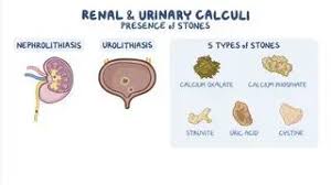 Image result for Calcium Nephrolithiasis
