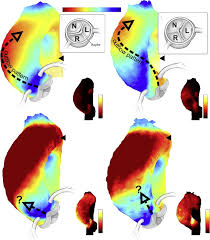 The Heart Valve Society