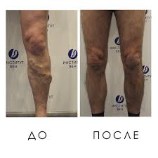 Vosstanovlenie Posle Miniflebektomii Institut Ven Lechenie Varikoza V Kieve I Harkove