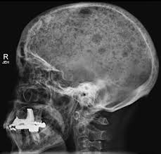Multiple myeloma (also referred to as myeloma) is a type of rare, incurable cancer of the blood—also known as hematologic cancer. Multiple Myeloma Radiology Case Radiopaedia Org