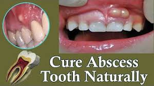 A dental abscess, also known as a gum boil, occurs when the nerve and blood vessel in the centre of a tooth becomes infected. September 26 2018 Boils Or Abscess On The Gums How To Treat Youtube
