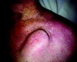 Is that pesky pacemaker still causing you trouble? Painful Eczema Mimicking Pocket Infection In A Patient With An Icd Circulation