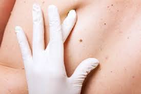 Xuất hiện các đốm nâu trên cơ thể, cảnh báo bệnh gì ở làn da?