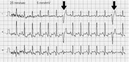 Le pause di più battute, battute d'aspetto, indicano il prolungato silenzio di uno strumento e sono utilizzate di frequente nelle partiture per la musica d'insieme. Extrasistole Wikipedia