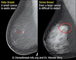Pin On Breast Density Resource Board