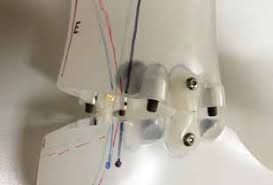 Neue Aspekte und Indikationshilfe zu Knöchel-Fuß-Orthesen mit Flexgelenken 