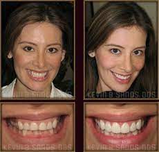 Porcelain Veneers Before And After Los Angeles Porcelain Veneers Before After Smile Gallery Photos Cosmetic Dentistry Beautiful Teeth Veneers Teeth