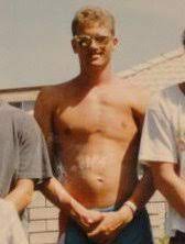 Poland Syndrome Wikipedia