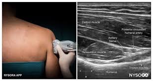 Image result for Axillary Nerve Block