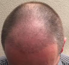 Viele patienten fragen vor der diese haare aus diesem bereich sind resistent gegen haarausfall. Fue Safe Haartransplantation 6000 Haaren Erfahrung Von Bruno Deutschland