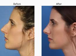 20 Year Old Female Patient From Manhattan Wanted The Bump Down And Her Nostrils In 2020 Nose Plastic Surgery Nose Job Rhinoplasty Before And After