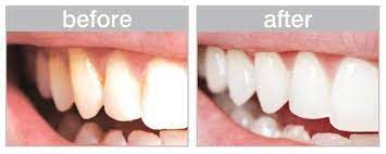 Before And After Deep Teeth Cleaning At Home Keepteethwhite Com Deep Teeth Cleaning Teeth Deep Cleaning Teeth Cleaning