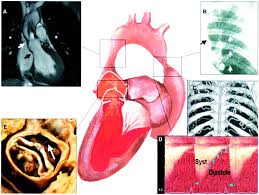 Image result for Left Ventricular Outflow Obstruction