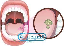 اعراض سرطان اللسان المبكرة وأسباب الإصابة به وطريقة الوقاية منه