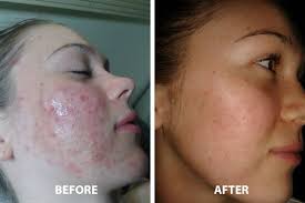 Acne Facials