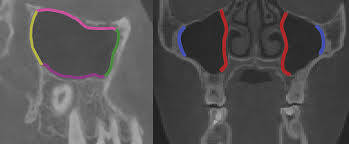 Image result for Maxillary Sinus