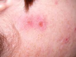 Diese art häuser findet man nicht so einfach in woodstock. Acne Excorie Dermnet Nz
