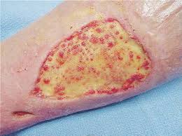 Maybe you would like to learn more about one of these? References In Short Contact Topical Tretinoin Therapy To Stimulate Granulation Tissue In Chronic Wounds Journal Of The American Academy Of Dermatology