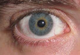 Hence, it is known that 1% have this globally. Datei Eye Central Heterochromia Jpg Wikipedia
