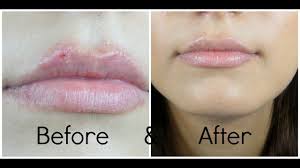 The problem with a cold sore is that the virus that causes them literally kind of sits around just waiting to be reactivated. How To Hide A Cold Sore Youtube