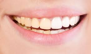 Karies ist eine der häufigsten zahnkrankheiten. Zahnverfarbungen Netdoktor At