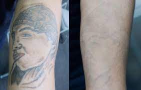 Here's what you should know before booking a tattoo removal appointment. San Pablo Edc Offers Low Cost Tattoo Removal Richmond Standard