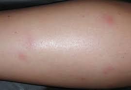 Image result for bedbug bites look like
