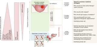 Prostate cancer can metastasize to other organs, but it is always prostate cancer, because it consists of mutated prostate cells. Accelerating Precision Medicine In Metastatic Prostate Cancer Nature Cancer