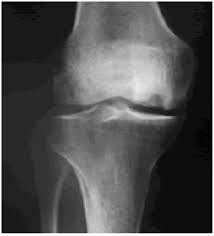 Image result for Knee XRay