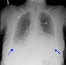 A pleural effusion is an abnormal collection of fluid in the pleural space resulting from excess fluid production or decreased absorption or both. Cureus A Case Of Seronegative Ana Hydralazine Induced Lupus Presenting With Pericardial Effusion And Pleural Effusion
